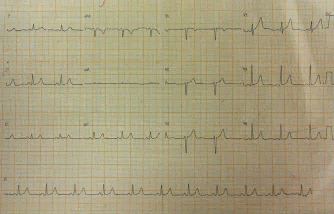 Mujer de 49 años con factores de riesgo que presenta episodio de ángor con desarrollo de síndrome de Wellens tipo 1 (presencia de ondas T bifásicas en derivaciones del plano horizontal) con reiteración del ángor a las 24 horas y evolución al óbito