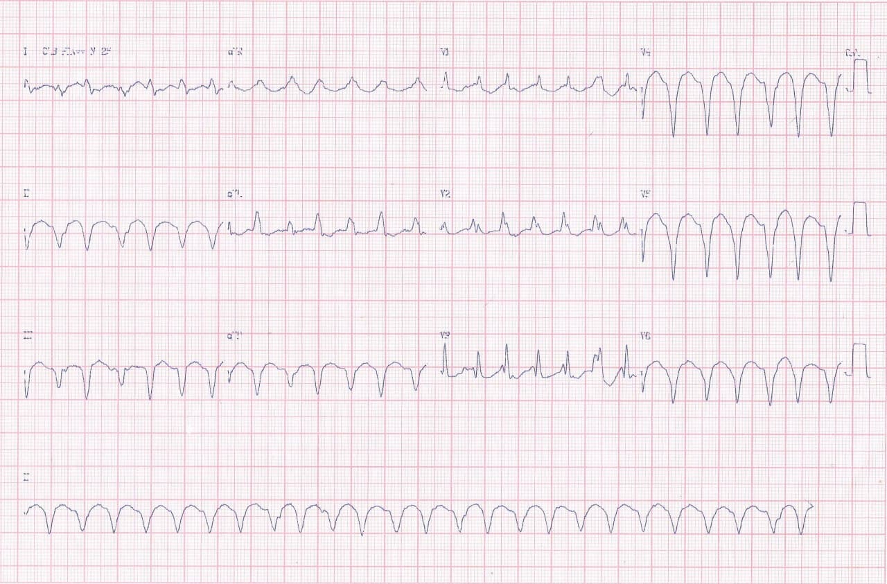 Mujer de 63 años, chagásica que presenta taquicardia de QRS ancho y presencia de gran aneurisma apical del VI