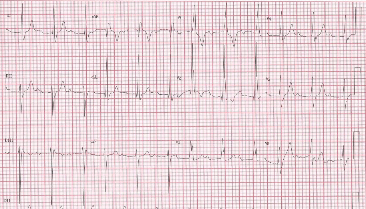 Trazado de paciente que presenta episodio sincopal relacionado a la presencia de bloqueo tetrafascicular