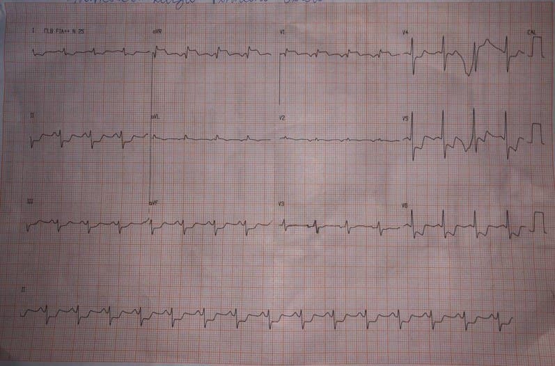 Hombre fumador de 65 años que presenta episodio de ángor prolongado de reposo por presencia de isquemia subendocárdica difusa por subocusión de tronco de coronaria izquierda