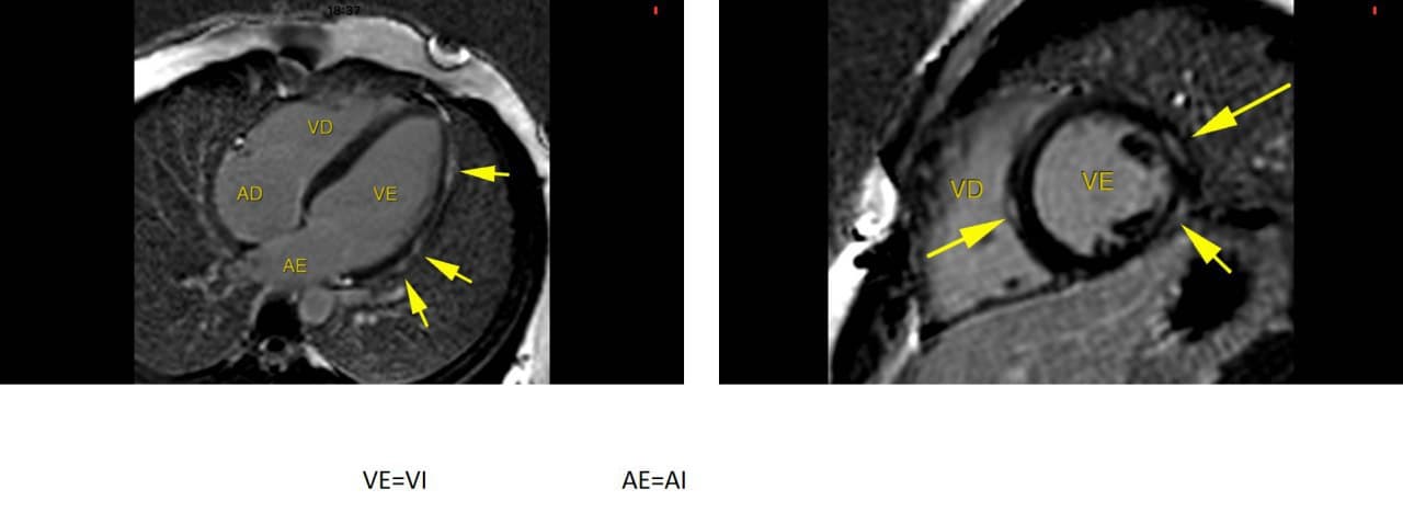 Paciente de 20 años asintomático con distrofia de Becker cuya RNM muestra signos de fibrosis