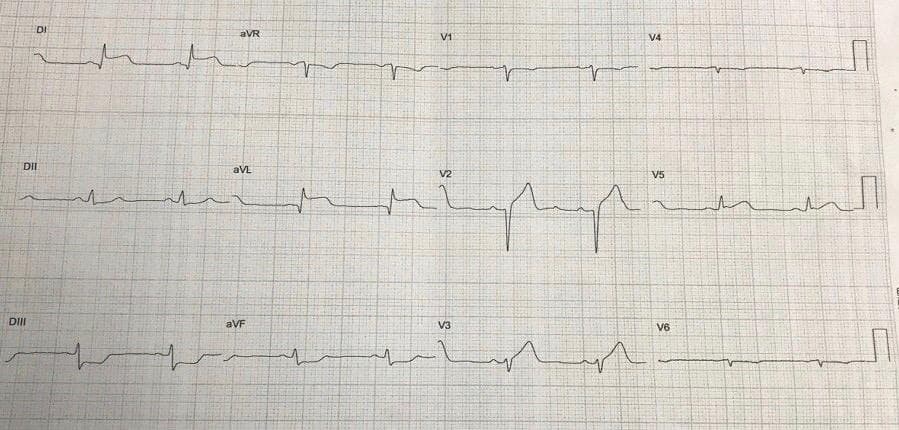 Mujer de 36 años que utiliza anticonceptivos que presenta episodio de ángor post esfuerzo intenso en quién se constata disección coronaria espontánea