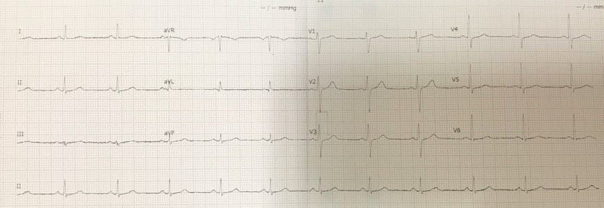 Hombre de 52 años que consulta por mareos y parestesias en mano derecha en quién se realiza RNM que constata lesiones isquémicas y un Eco TE demuestra existencia de FOP y aneurisma del tabique interauricular con confirmación del shunt por Doppler transcraneal expresión de embolia paradojal descripta por Cohnheim