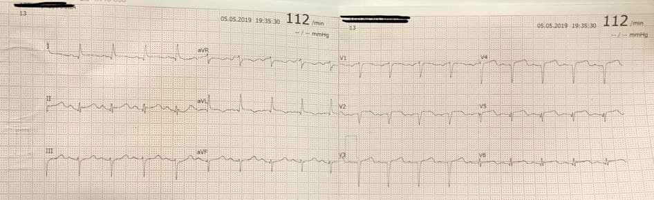 Mujer de 89 años con disnea, hipotensión y abundantes secreciones bronquiales por infección respiratoria en la que se detecta miocardiopatía de tako tsubo