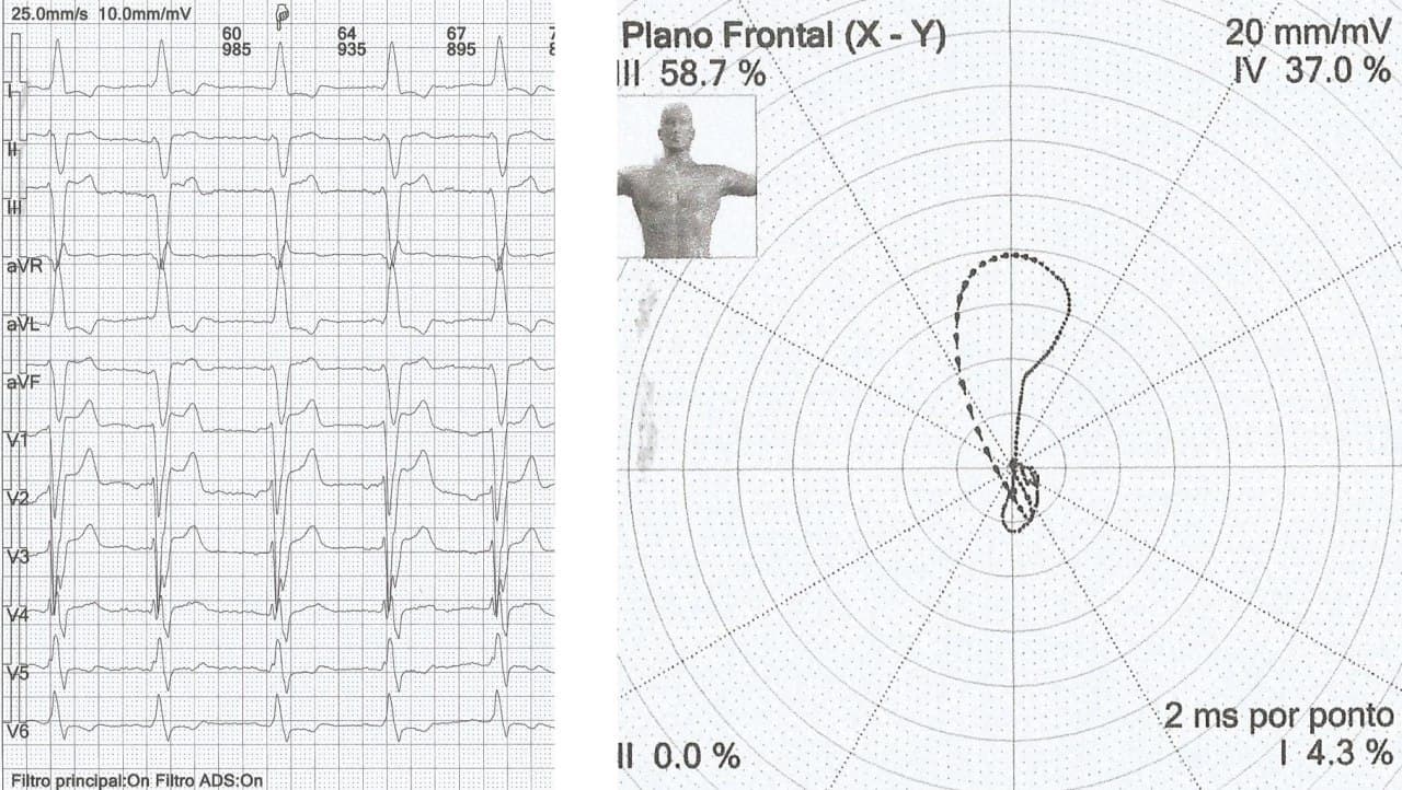 Hombre de 49 años con insuficiencia cardíaca y presencia de BRI que permite analizar sus características según Wellens
