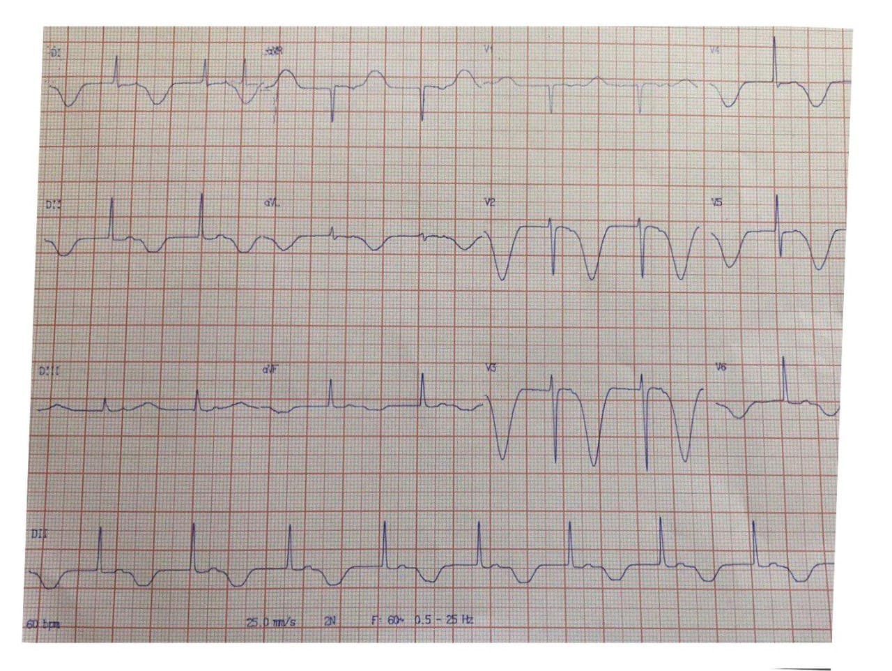 Trazado ECG de paciente que padece severa hipertensión endocraneana por hemorragia cerebral intraparenquimatosa con prolongación del QT y ondas T negativas gigantes de tipo cerebral
