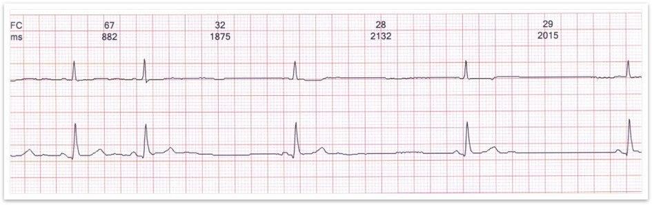 Anciano con mareos que presenta bloqueo sinoauricular de grado variable