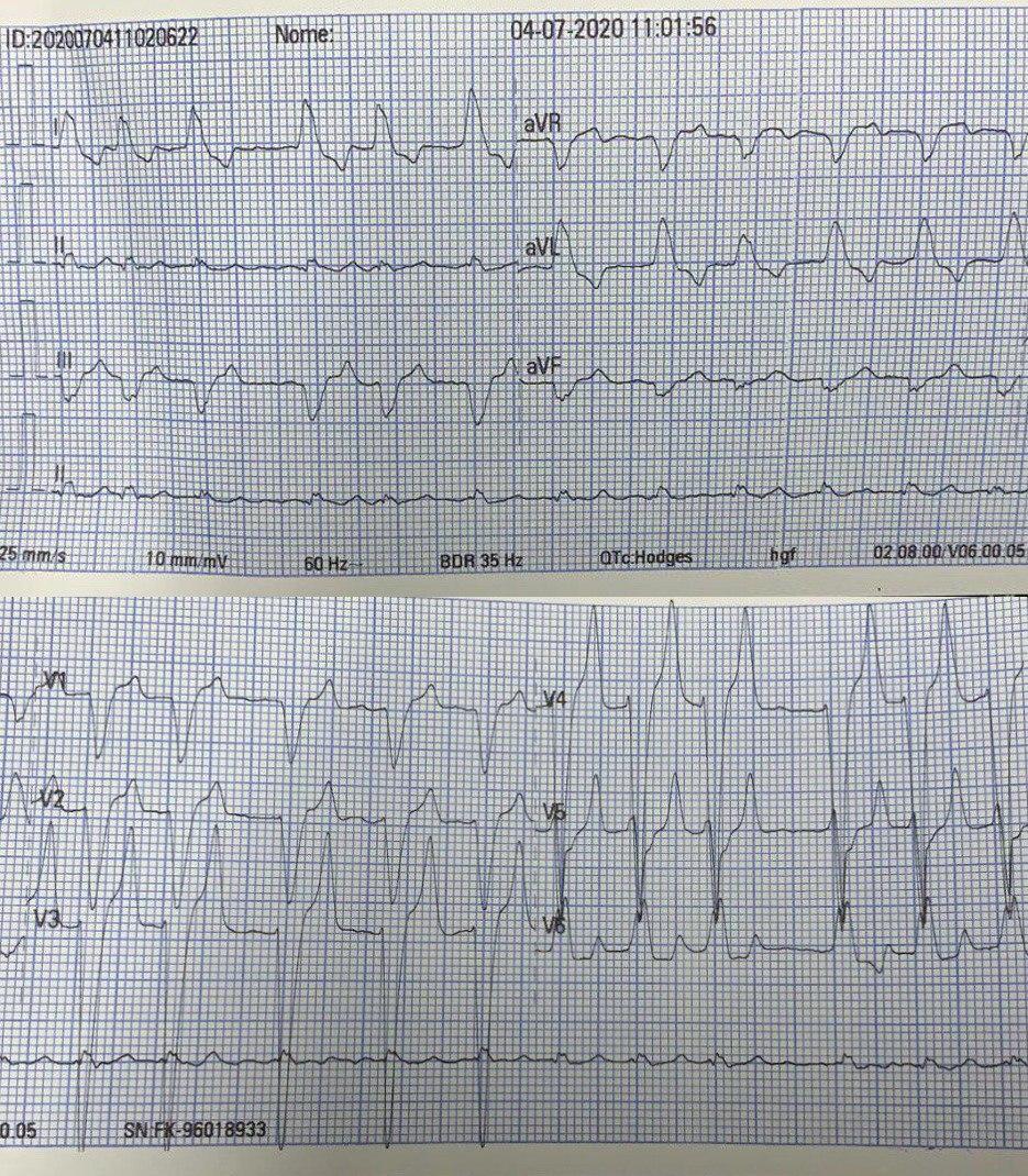 Hombre de 51 años en shock séptico que presenta FA con QRS ancho BCRI like por kiperkalemia