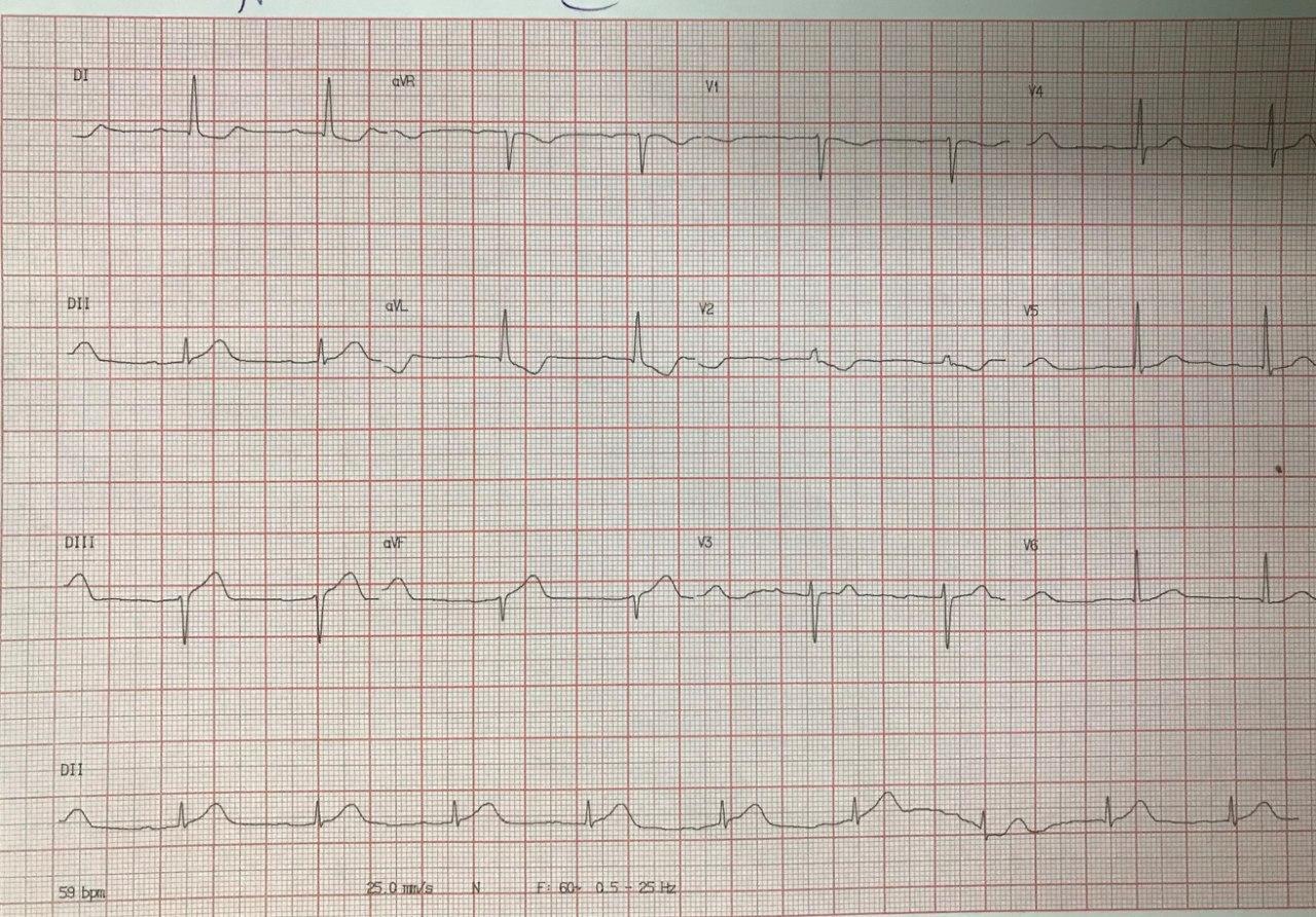 Hombre hipertenso de 78 años que presenta episodio de ángor prolongado acompañado de síntomas vagales cuyo ECG muestra isquemia grado I por compromiso de la CD