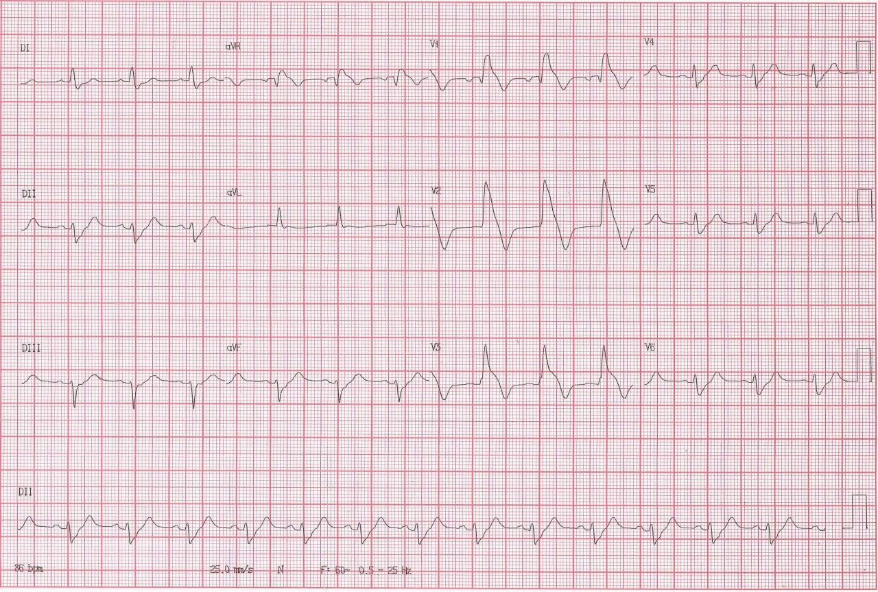 Paciente de 67 años que ingresa con cuadro de SCA que es tratado con angioplastia primaria a la DA (con presencia de trombo) luego de la cuál se pone de manifiesto un típico patrón Brugada tipo I