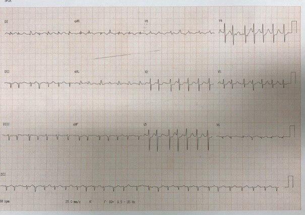 Paciente de 61 años con factores de riesgo y antecedentes de FA que cursa SCA por compromiso de la Cx