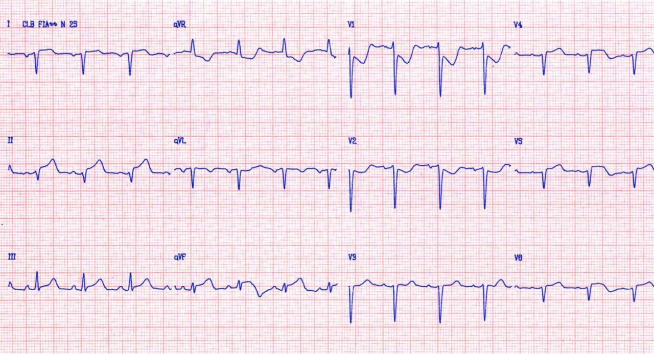 Paciente portador de dextrocardia que cursa SCA por compromiso de la CD