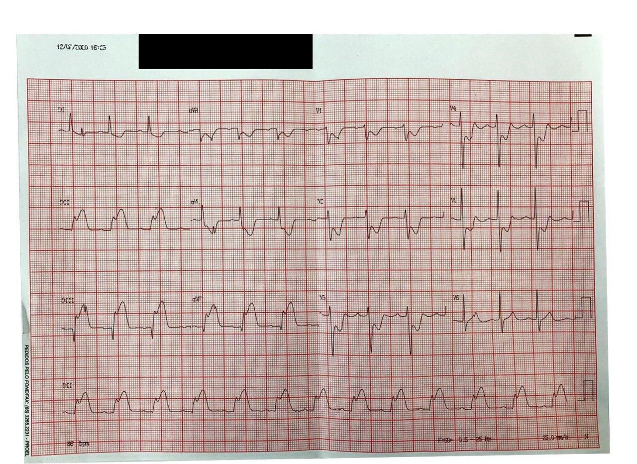 Hombre de 59 años, hipertenso y diabético, que presenta episodio de ángor y síntomas vaso-vagales por desarrollo de IAM inferior constatándose una obstrucción del 100% en la CD y 80% en la DA proximal