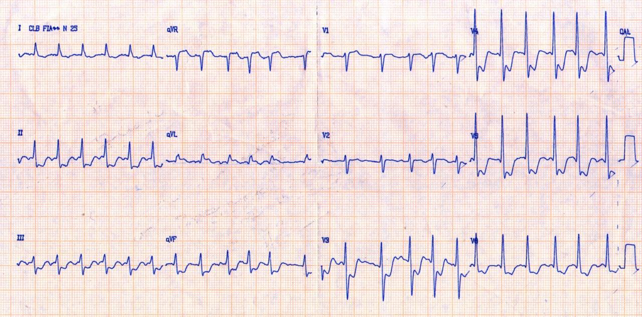 Hombre de 74 años cursando SCA con antecedente de cirugía de revascularización coronaria con puente de mamaria interna a la D y un injerto venoso a la marginal de Cx que presenta hipoflujo por obstrucción de la subclavia generando isquemia circunsferencial
