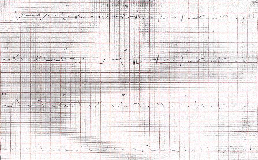 Varón de 20 años con cuadro de SCA y diarrea en quién se constata trombo en DA y CD proximal que presenta BAV variable y BRD