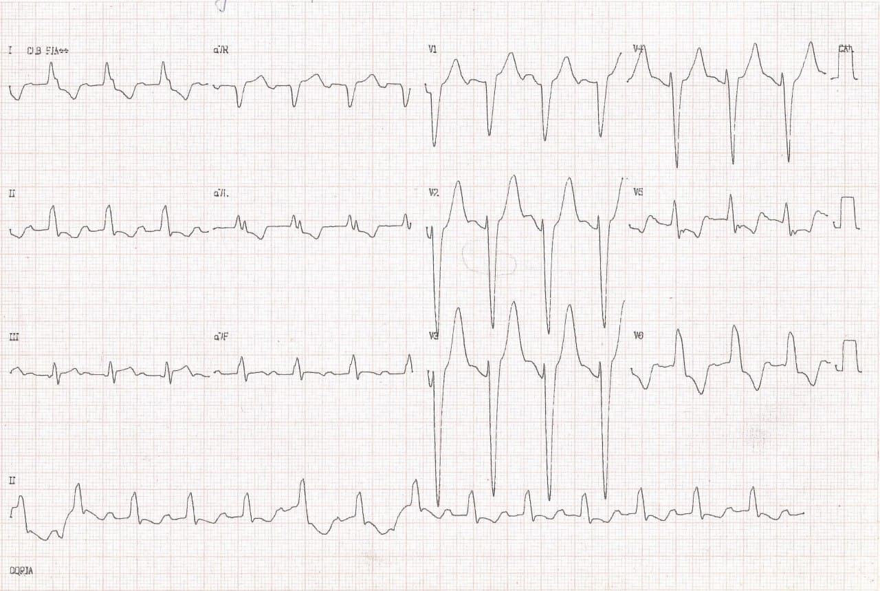 Hombre hipertenso de 71 años que presenta cuatro episodios sincopales