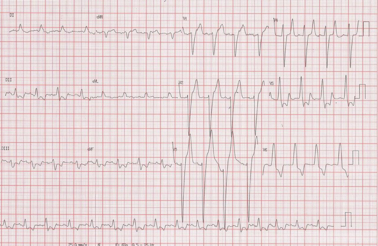 Paciente masculino de 72 años con factores de riesgo que presenta angina de reciente comienzo de 1 semana de evolución cuyo ECG presenta ondas T picudas en quién se detectó puente miocárdico sobre DA y que presenta franca hiperkalemia en contexto de insuficiencia renal