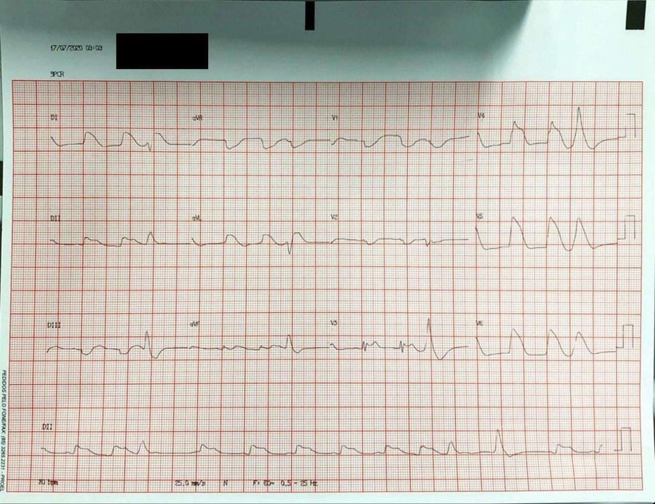 Trazado correspondiente a un paciente que es sometido a maniobras de reanimación cardiopulmonar y recibe trombolisis realizada con tenecteplase y en quién se constata lesión CX total con trombo y suboclusión de DA