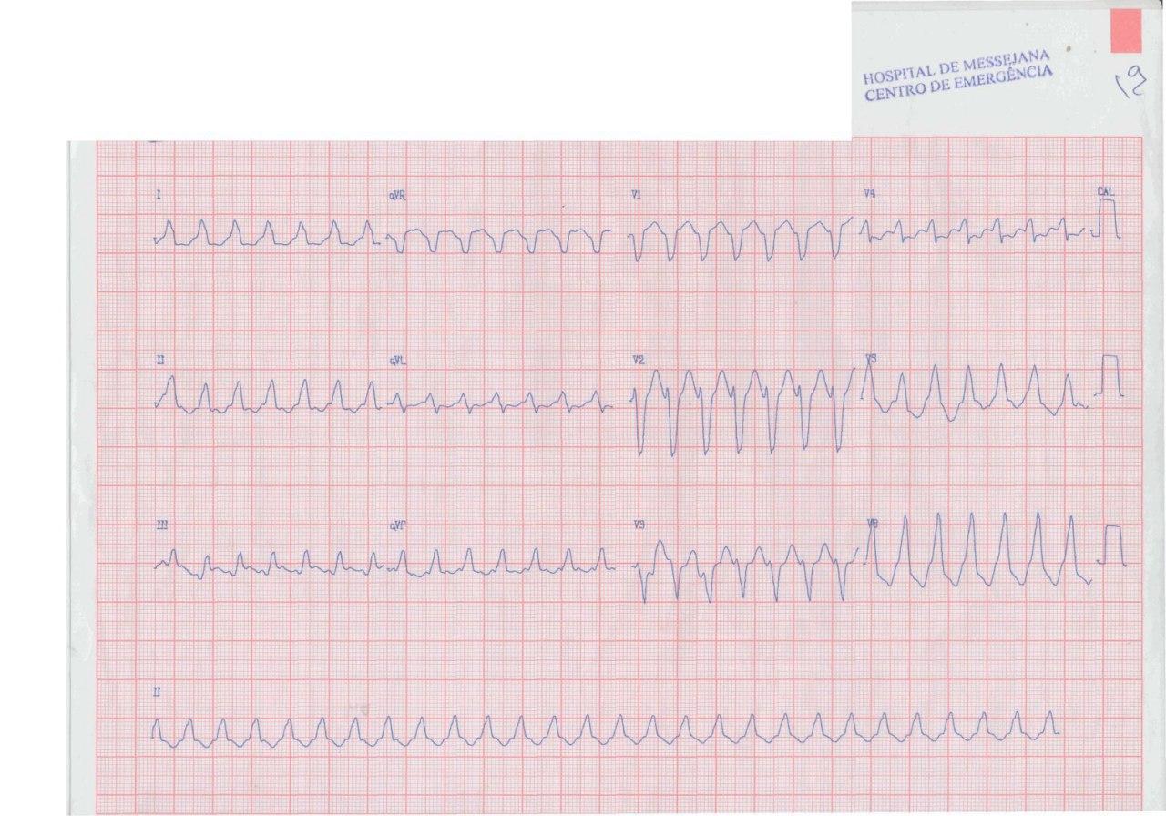 Mujer hipertensa de 71 años que refiere «aceleración del corazón» en la cuál se constata aleteo auricular 1:1 con conducción aberrante que responde a adenosina