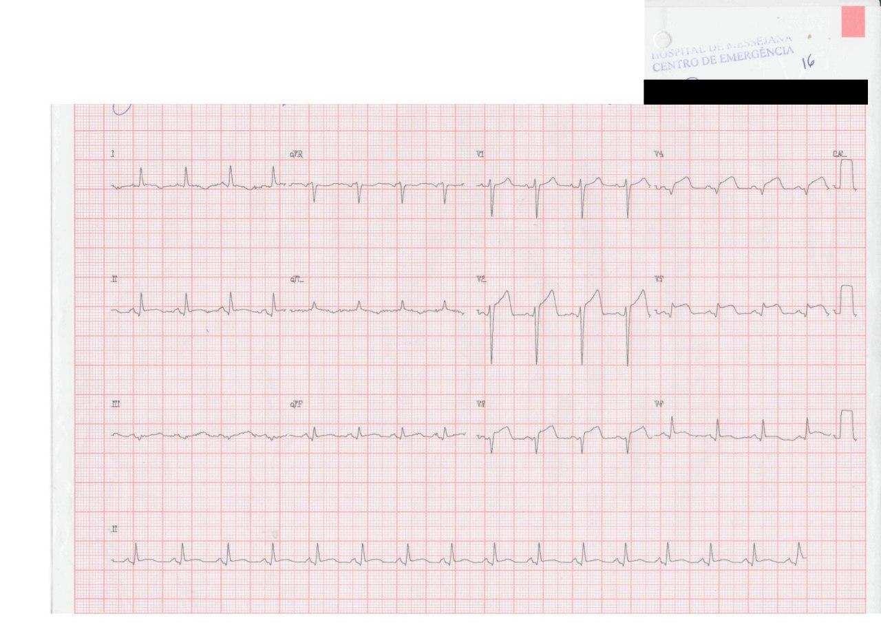 Paciente que padece una ruptura de pared libre de VI una semana después de padecer un IAM