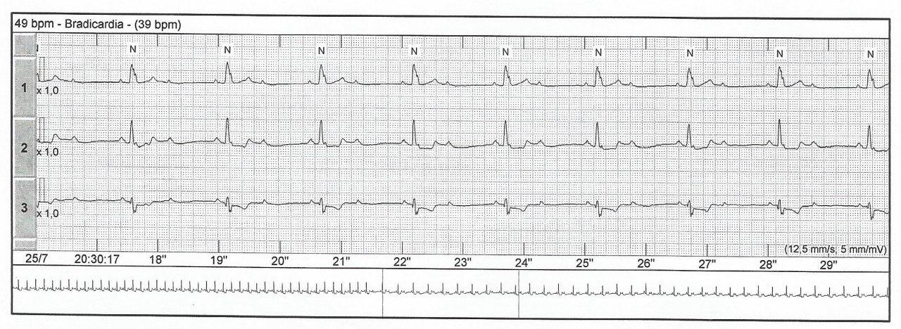Hombre de 71 años, HTA y DBT que presenta episodio sincopal por presencia de BAV de grados variables de localización infrahisiana