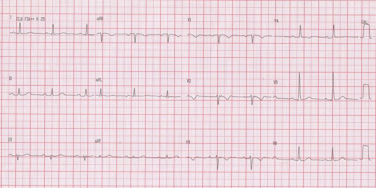 Varón de 23 años que padece episodio sincopal durante esfuerzo cuyo ECG muestra ondas épsilon en V1, V2, V3 característicos de displasia arritmogénica de VD comprobada por RNM