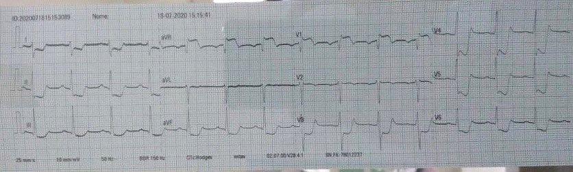 Paciente masculino de 26 años, cursando COVID-19, complicado con cuadrp de TEP que requiere ventilación mecánica, presentó descompensación con paro cardiorrespiratorio y evolución al óbito