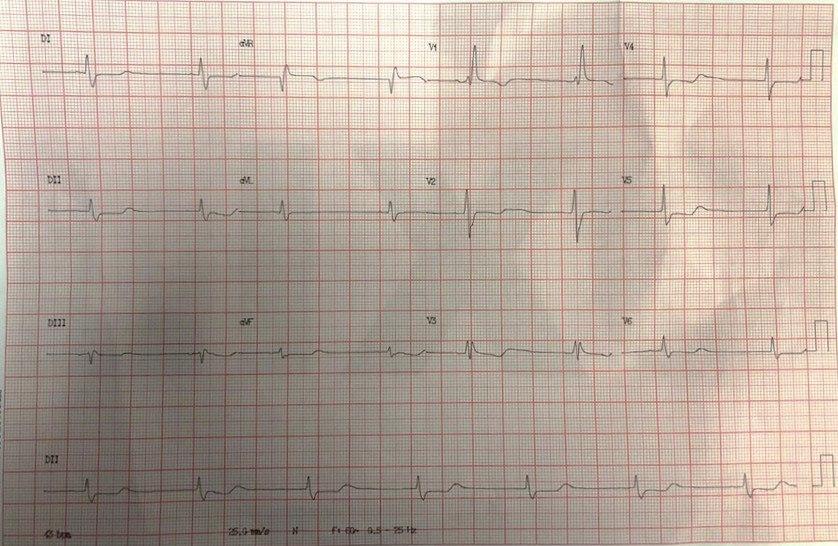 Mujer de 68 años con antecedentes de palpitaciones a quién se realiza PEG que es detenida por presentar disnea y desarrollo de TV en monitor, cuyo ECG basal presenta disociación isorrítmica por severa hipokalemia e hipocalcemia