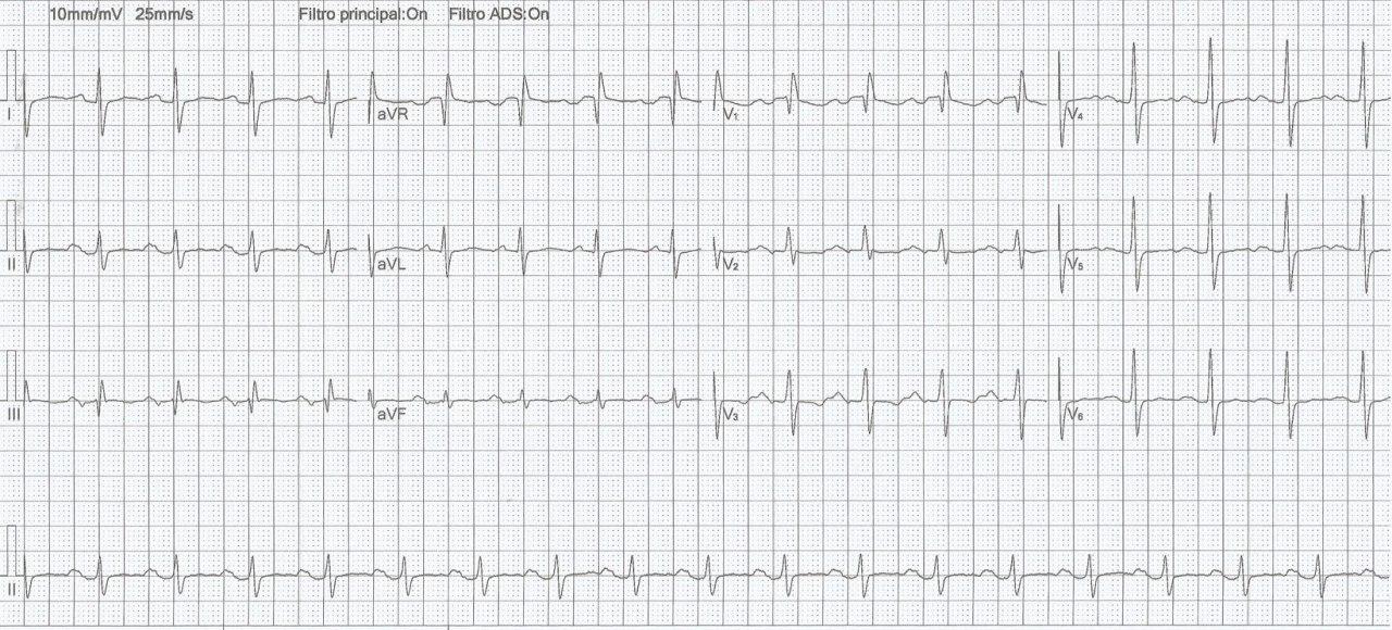 Mujer de 37 años con valvulopatía reumática que muestra el bucle de P en el  el PH desplazado completamente hacia atrás y gran desplazamiento posterior del bucle P en el plano sagital derecho por SAI + SVD + BIA de una estenosis mitral