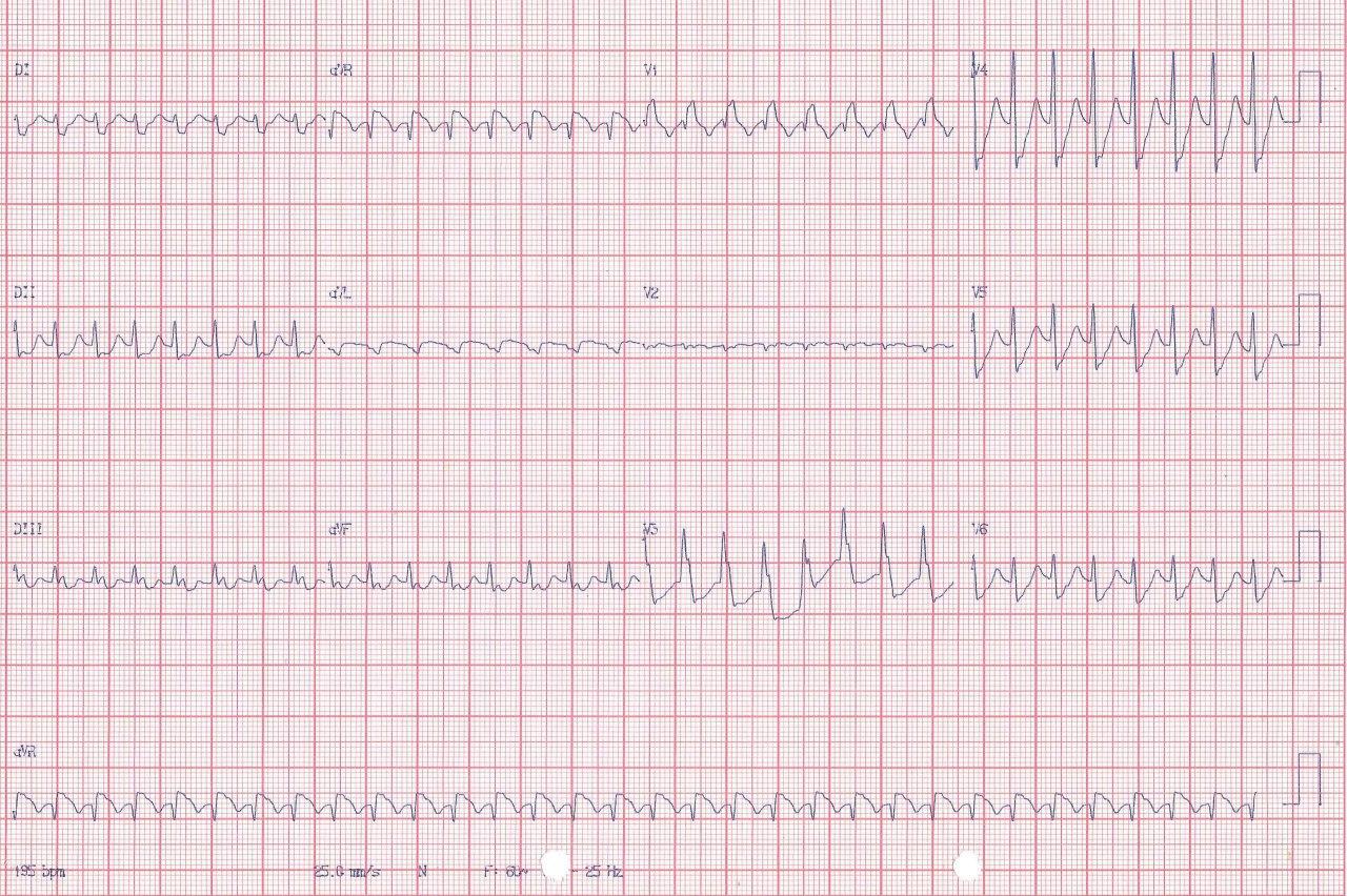 Trazado correspondiente a paciente hipertenso de 57 años con taquicardia regular con QRS ancho con ST elevado en AVR durante la taquicardia que sugiere TRAVO