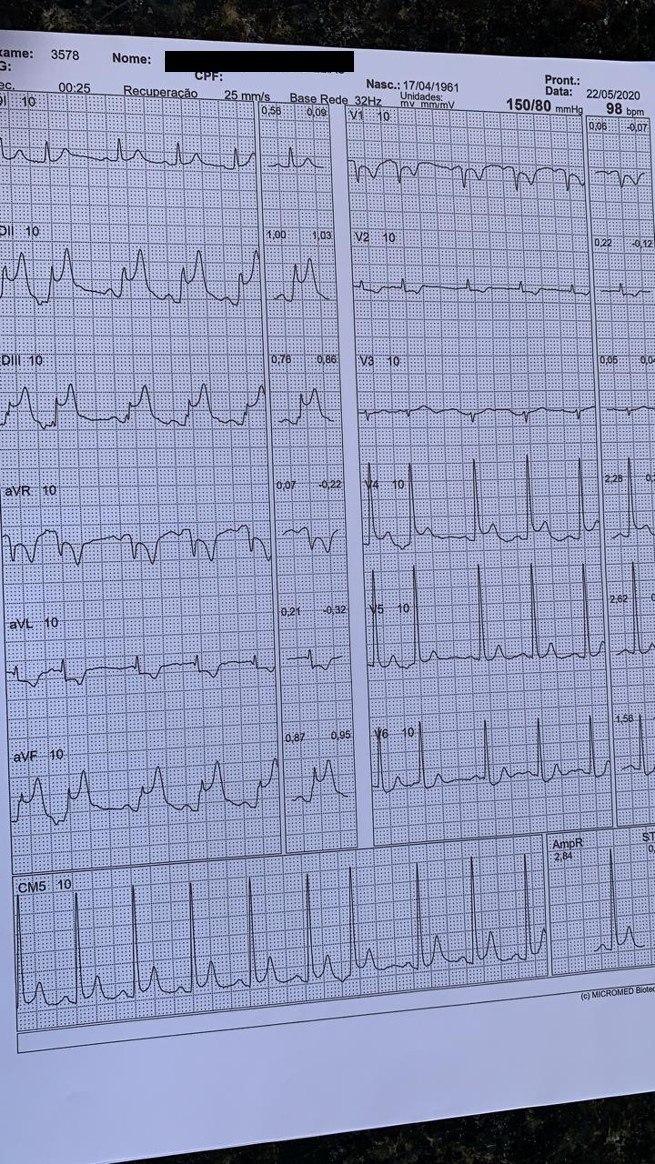 Hombre de 55 años con ángor de varias semanas de evolución que durante PEG presenta dolor y sobreelevación del segmento ST en cara inferior constatándose espasmo de arteria CD