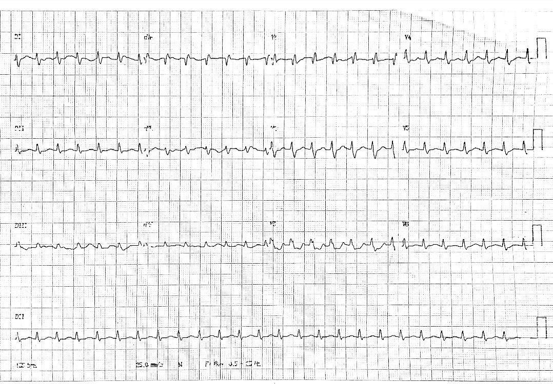 Hombre diabético recuperándose de síndrome respiratorio agudo por COVID 19 que presenta taquicardia auricular automática que no responde a adenosina y sí posteriormente a Mg