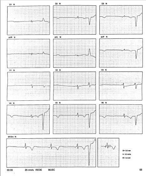Mujer de 40 años, maratonista cuyo ECG presenta complejos de muy bajo voltaje, ritmo auricular inferior y EVs a quién se realiza RNM, que sugirió miocarditis, quizás en fase subaguda por la presencia de edema en región lateral, que posteriormente desarrolla MS