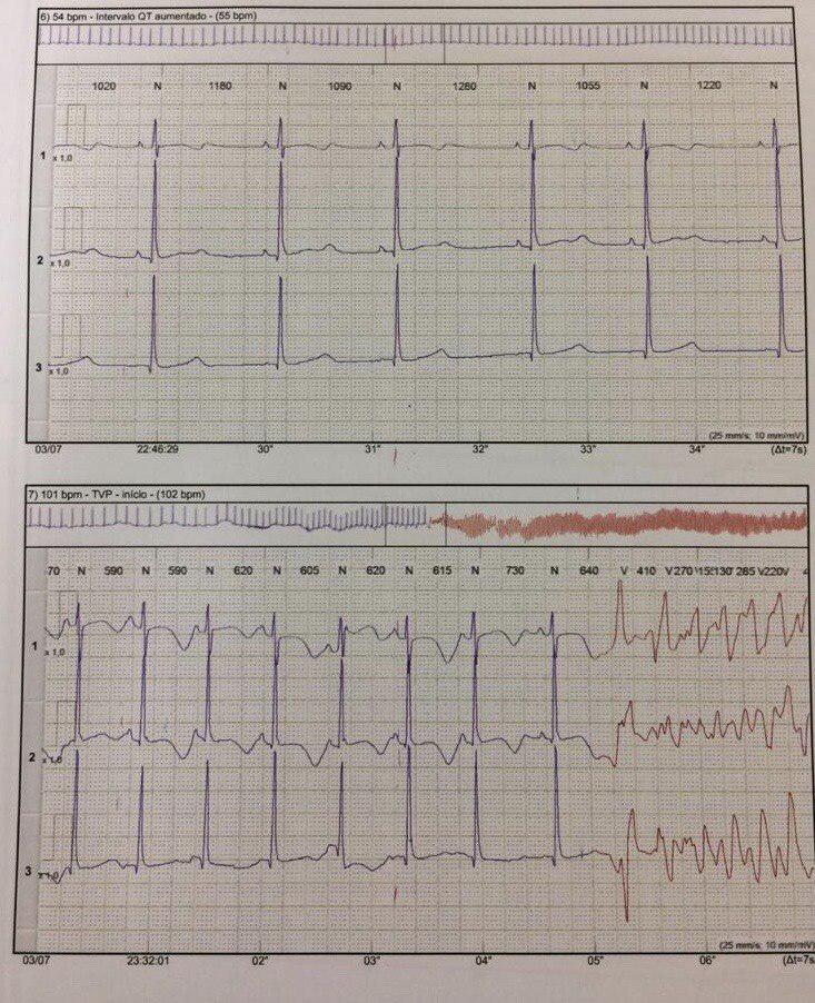 Mujer atleta de 34 años que presenta palpitaciones intermitentes y presíncope que durante la noche presenta microalternancia de ondas T y desarrollo de TdP