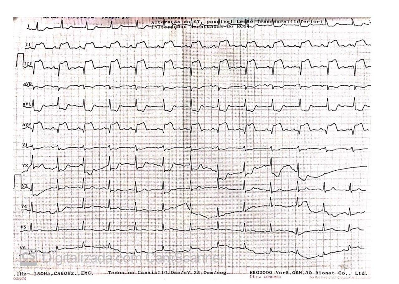 Hombre de 73 años cursando IAM inferior de más de 48 horas por lesión de CD total, MgCx y DA con obstrucciones graves y compromiso de VD