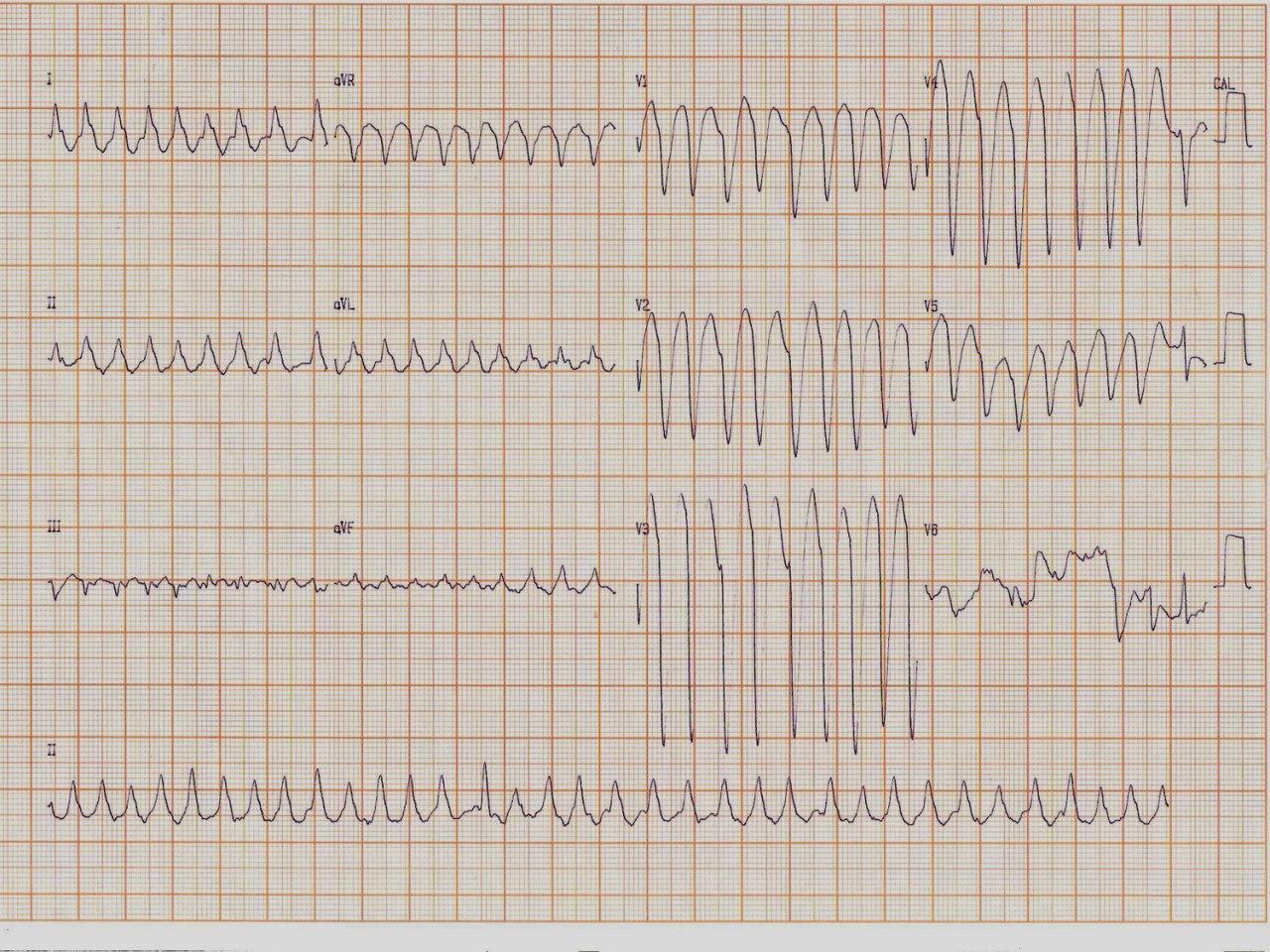 Hombre de 49 años, alcoholista y portador de miocardiopatía dilatada, con severa dilatación de AI con trombos que presenta FA con aberrancia que requiere CVE