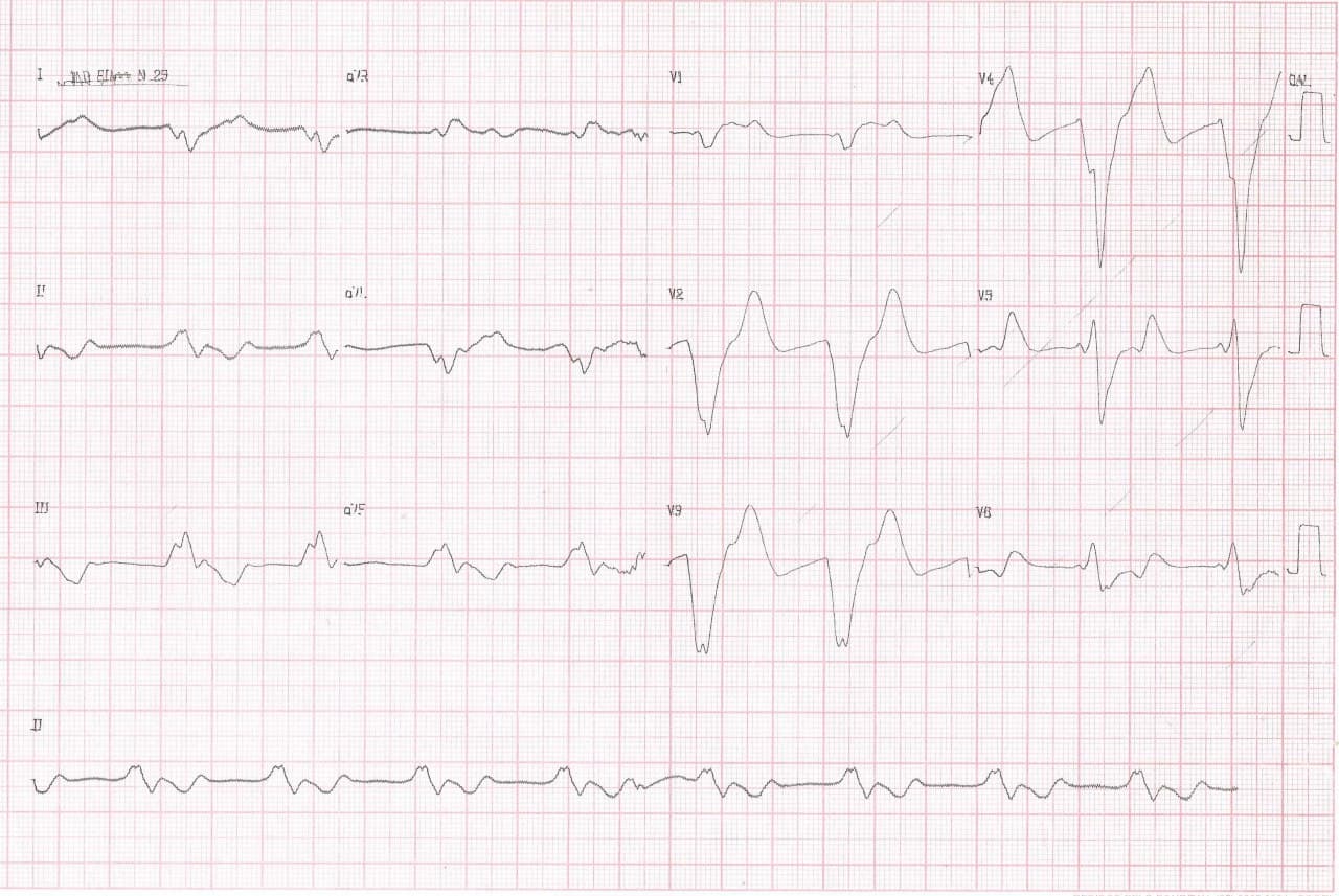Hombre de 60 años con dificultad para respirar cuyo ECG presenta desaparición de ondas P, complejos QRS amplios, a menudo con morfología bizarra por severa hiperpotasemia