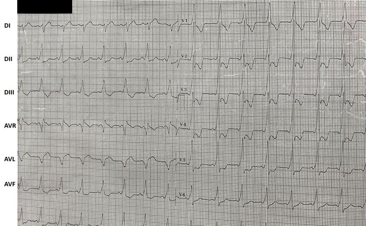 Hombre de 36 años, usuario de cocaína con dolor precordial opresivo y palpitaciones en quién se constata vía anómala lateral izquierda (delta negativa en DI y aVL) con troponina negativa y CCG normal con pruebas negativas para espasmo, con diagnóstico presuntivo final de TPS