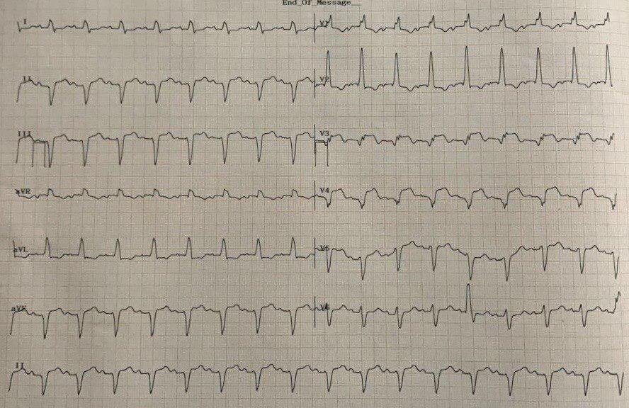 Paciente de 83 años con antecedente de epigastralgia crónica con empeoramiento actual por SCACEST anterior + BDAM + HBAI por compromiso de tercio medio de DA total en contexto de enfermedad de tres vasos