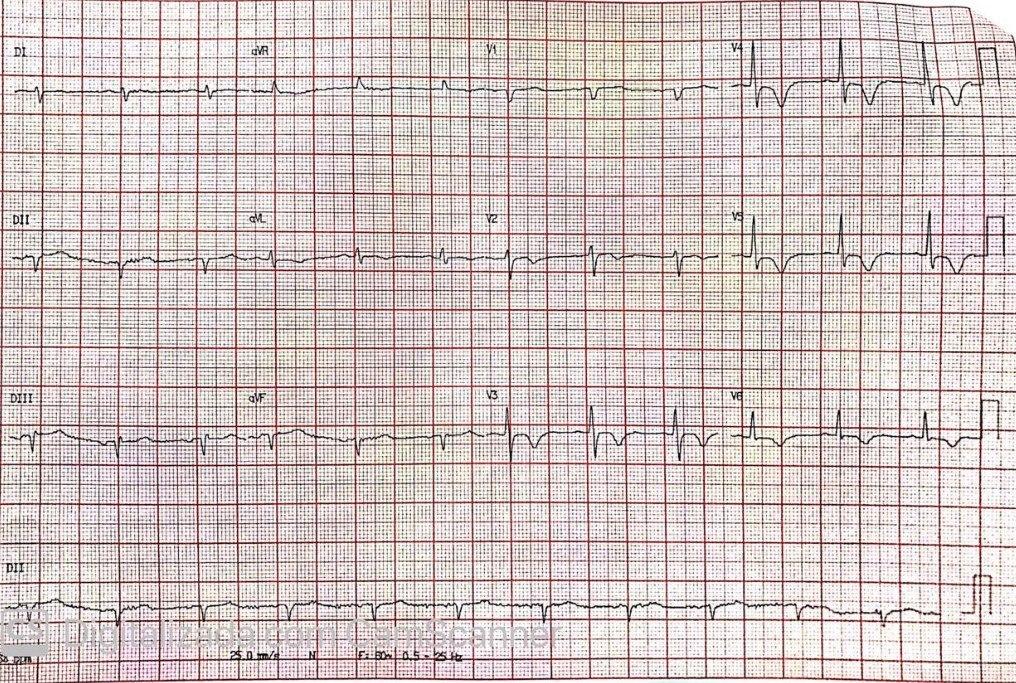 Mujer de 74 años COVID 19 +, HTA y DBT, que presenta dolor epigástrico de 10 días de evolución, con troponina elevada y arterias coronarias normales que desarrolla síndrome de TakoTsubo