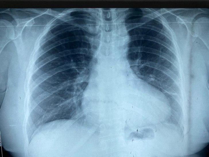 Hombre de 57 años, HTA, que manifiesta precordialgia de esfuerzo, con soplo paraesternal izquierdo y signos de HVI y muescas costales por circulación colateral en presencia de coartación aórtica