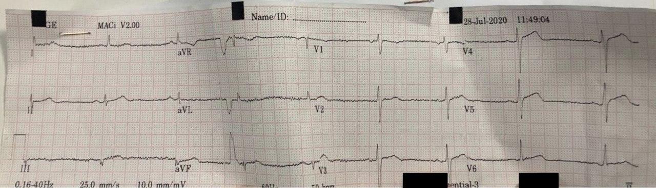 Hombre de 65 años con episodio de ángor de reposo que desarrolla síndrome de Wellens por suboclusión con trombo de la DA