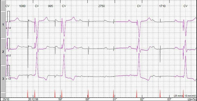 Paciente de 54 años con MP bicameral definitivo por episodios sincopales y otros catalogados de «epilepsia» por episodios frecuentes de pérdida de captura del canal ventricular