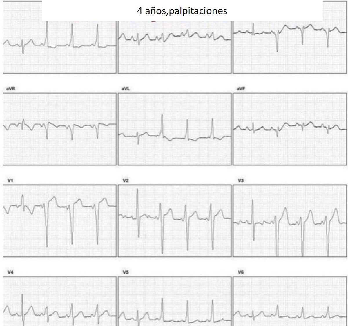 Niño de 4 años con palpitaciones y malestar general que presenta síndrome de WPW intermitente con desarrollo de TRAVO