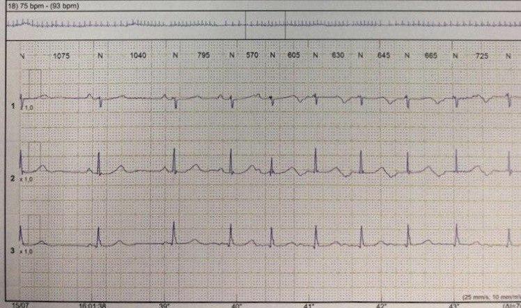 Mujer de 66 años con antecedentes de diabetes tipo II que presenta palpitaciones por salvas de taquiardia de QRS angosto en el Holter sugestiva de taquicardia reciprocante permanente por reentrada de la unión AV, de Coumel por vía accesoria de conducción lenta retrógrada