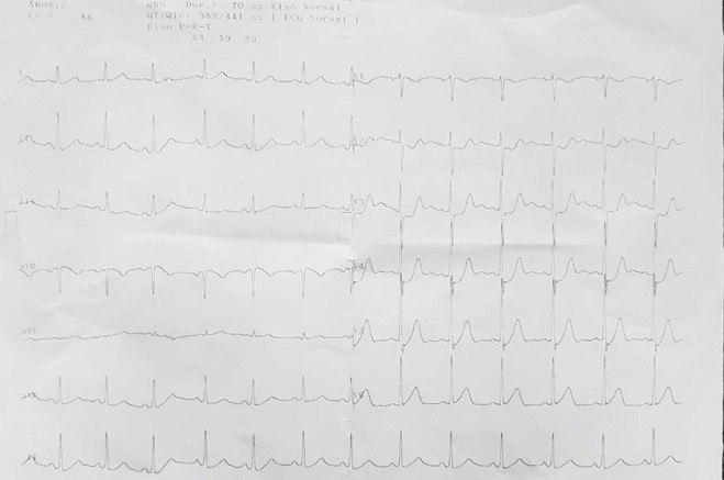 ECGs seriados de hombre de 62 años, HTA y DBT con episodio de ángor  prolongado que corresponde a un IAM en territorio de Cx
