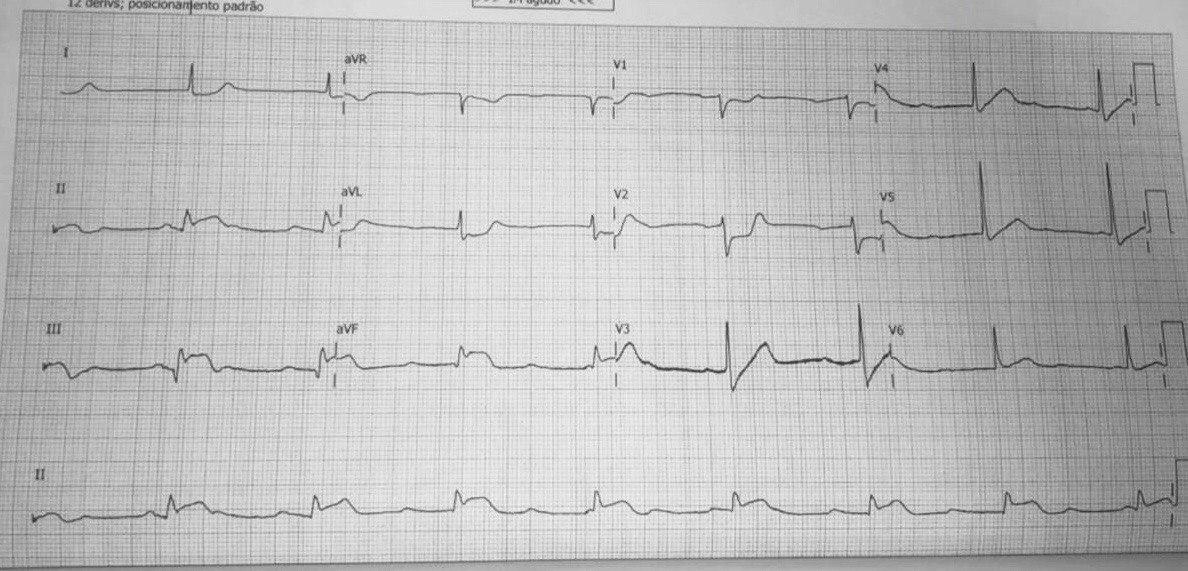 Paciente de 62 años que presenta un IAM inferior procediéndose a implante de stent en CD y en segundo procedimiento a la  CX-MgE  reingresando por nuevo episodio por trombosis aguda del stent por interrupción temprana de la doble terapia antiplaquetaria con alta carga de trombo con aspiración exitosa