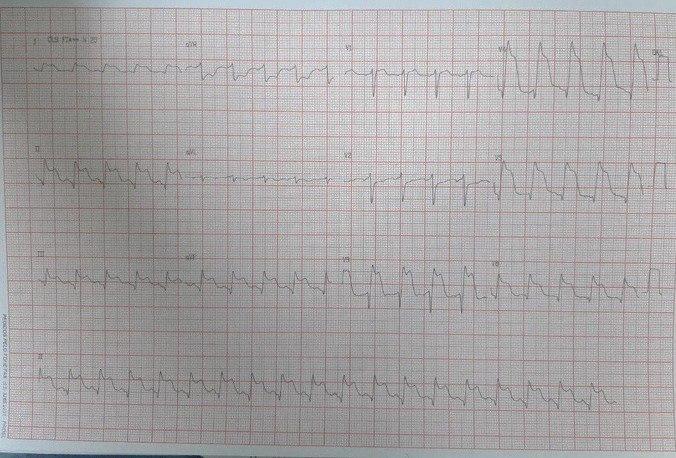 Mujer de 64 años que presenta episodio de ángor observándose manifestaciones de SCA con presencia de ondas lambda con hallazgo de arterias coronarias tortuosas y balonamiento apical típico de síndrome de Tako Tsubo