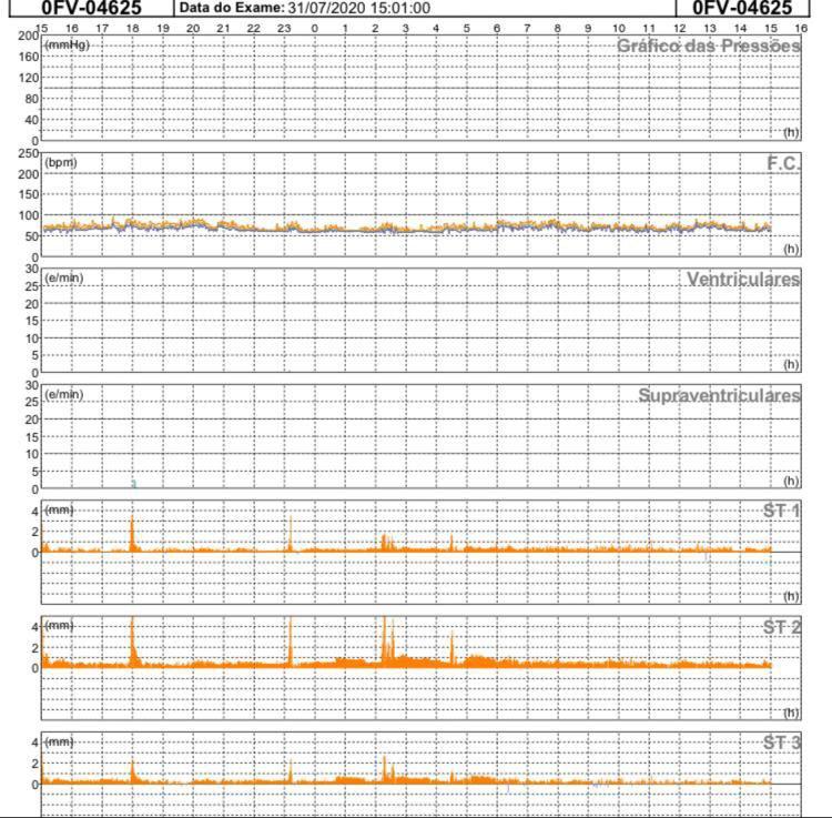 Paciente masculino que refiere episodios de ángor nocturno de reposo y cuya CCG mostró una lesión obstructiva del 50% en la arteria descendente anterior a quién se realiza ECG de Holter