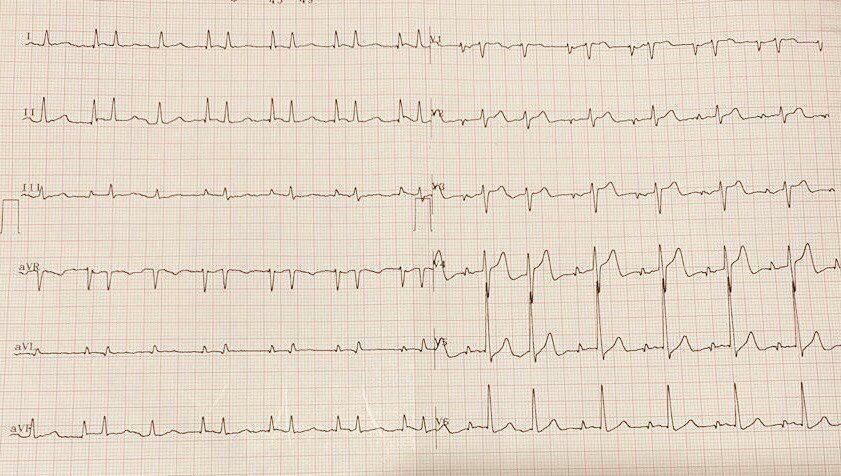 Paciente de 81 años con MP permanente medicado con B bloqueantes orales y en colirio que ingresa somnoliento e hipotenso cuyo ECG muestra estimulación auricular predominante + lesión auricular (elevación del PR) + latidos ectopicos auriculares
